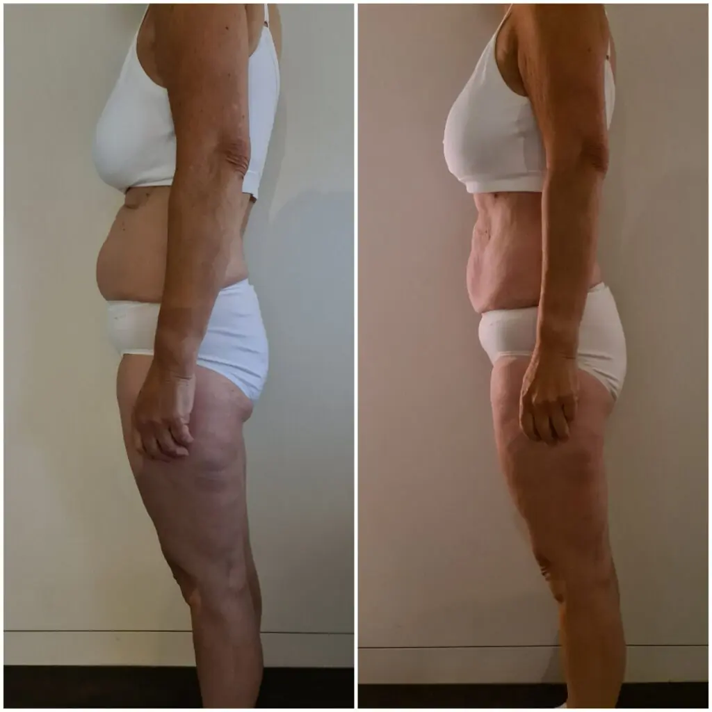 Voor en na resultaat van Karen, 45